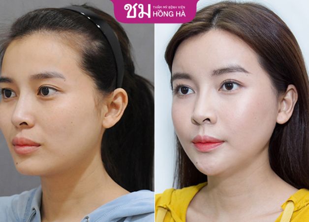 Sự thay đổi rõ rệt ở vị trí cằm và diện mạo tổng thể