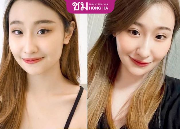 Chi phí phẫu thuật tại Thẩm mỹ Bệnh viện Hồng Hà phù hợp