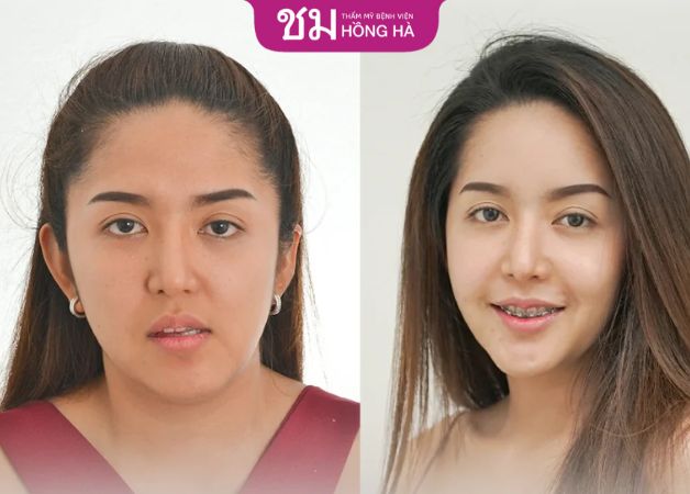 Thẩm mỹ Bệnh viện Hồng Hà, địa chỉ ghép xương cằm và gọt hàm Thái Lan uy tín