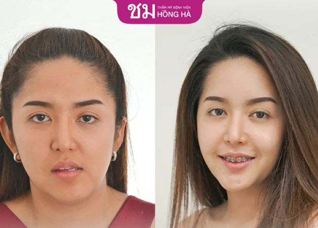 Kết quả gọt hàm Vline của khách hàng tại Hồng Hà