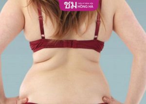 Hút mỡ lưng có nguy hiểm không? Hút mỡ ở đâu hiệu quả tối ưu