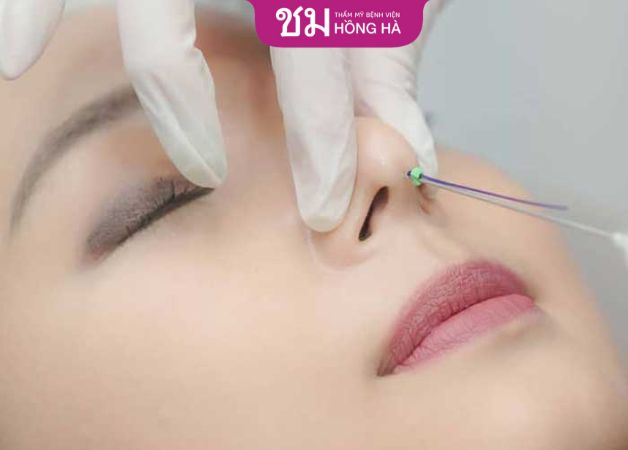 Hút dịch sau khi nâng mũi là việc làm cần thiết