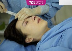 Hút dịch sau khi nâng mũi có đau không? Thời gian nên hút