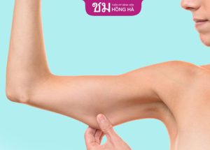 Hút mỡ bắp tay được bao lâu? Địa chỉ hút mỡ tay hiệu quả nhất