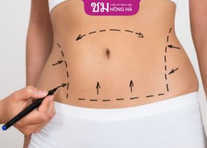 Hút mỡ an có toàn không? Quy trình hút mỡ lấy lại eo thon