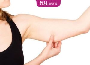 Hút mỡ bắp tay bao lâu hết sưng – Cách giảm sưng cấp tốc