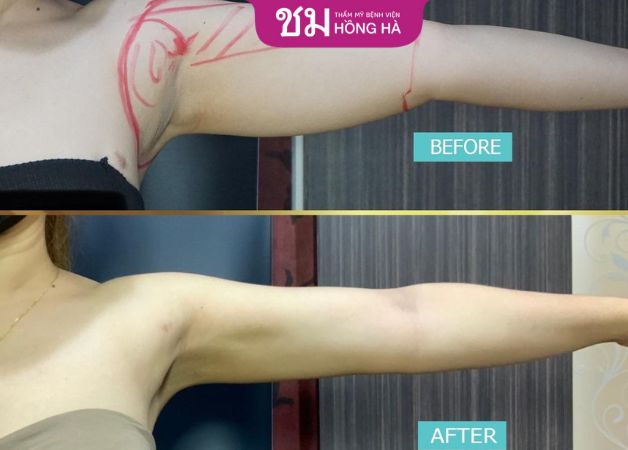 Kết quả hút mỡ bắp tay làm hài lòng khách hàng