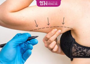 Hút mỡ bắp tay kiêng ăn gì – Top 5 thực phẩm cần tránh