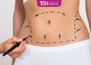 Hút mỡ bụng phải nịt bụng bao lâu – Chăm sóc hồi phục nhanh