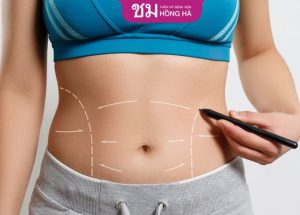 Hút mỡ bụng: An toàn và hiệu quả – Những điều cần biết trước khi thực hiện