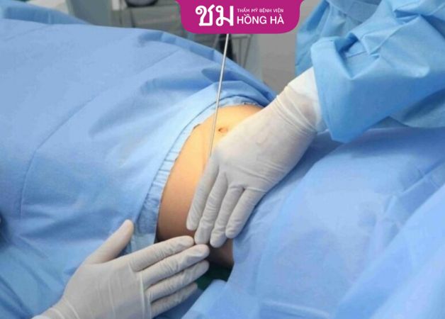 Thực hiện hút mỡ bụng sở hữu eo thon