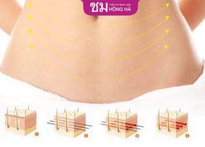 Hút mỡ bụng trên bao lâu thì đẹp – 3 lưu ý sau hút mỡ nhanh lành