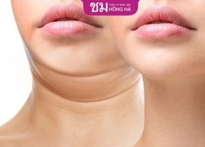 Hút mỡ cằm – Loại bỏ 99% mỡ thừa, khôi phục đường nét khuôn mặt