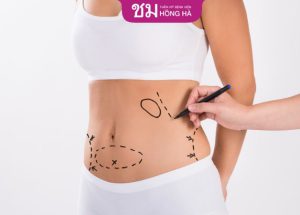 Hút mỡ có an toàn không? Có để lại di chứng gì không?