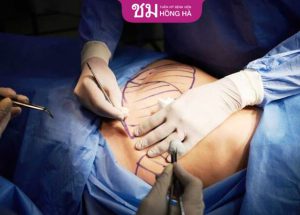 Hút mỡ nội soi – Giải pháp loại bỏ mỡ an toàn và hiệu quả