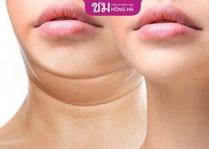 Hút mỡ nọng cằm: Loại bỏ cằm 2 ngấn chỉ sau 60 phút