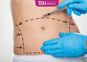 Hút mỡ tạo hình bụng: Giải pháp lấy lại vòng 2 thon mịn hiệu quả