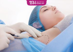 Hút nội soi tuyến mồ hôi nách: Loại bỏ mùi hôi chỉ sau 1 lần