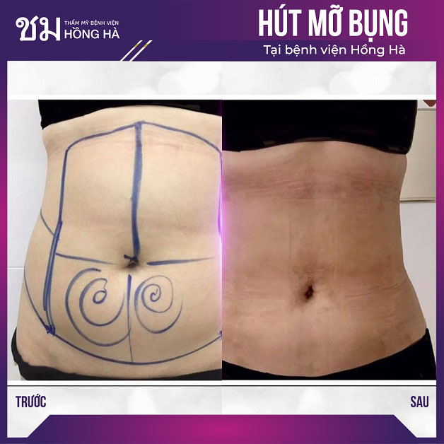 Khách hàng sở hữu vòng eo thon gọn khi hút mỡ tại Hồng Hà