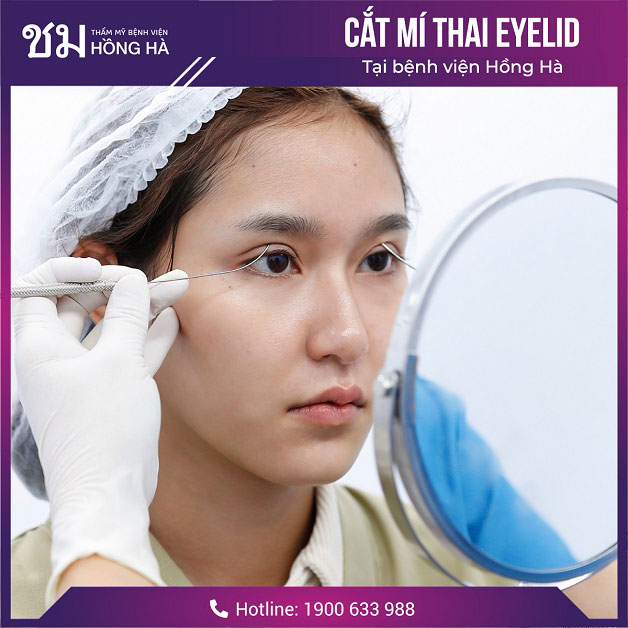 Thẩm mỹ mắt tại Thẩm mỹ Bệnh viện Hồng Hà đem kết quả tuyệt vời