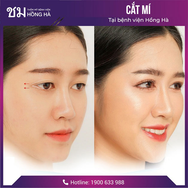 Khắc phục tình trạng mắt mí sụp thành đôi mắt 2 mí đẹp tự nhiên