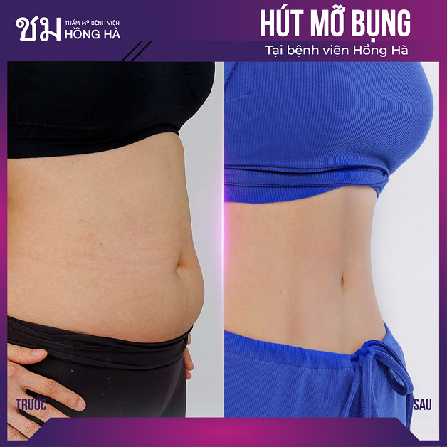 Hút mỡ sạch 99% với công nghệ Thai Hi-Lipo tại Hồng Hà