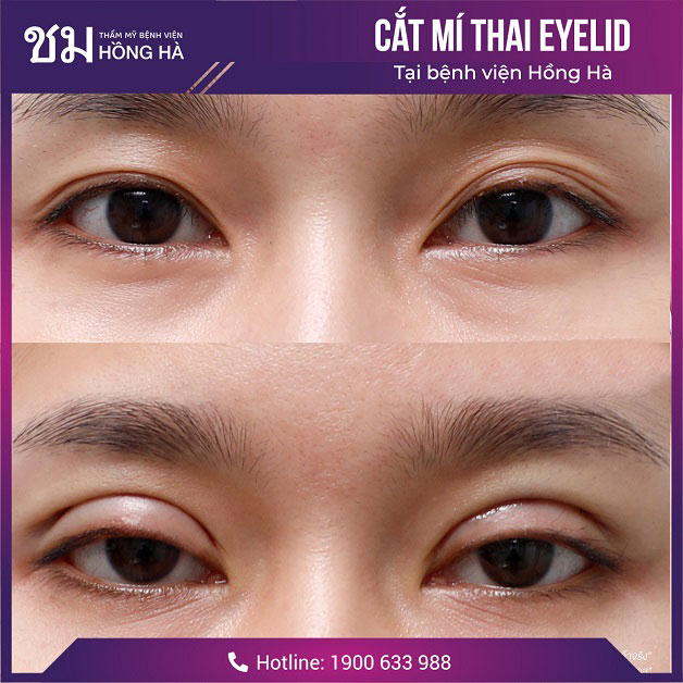 Cắt mí Thai Eyelid giúp chỉnh sửa thành mắt 2 mí đẹp tự nhiên