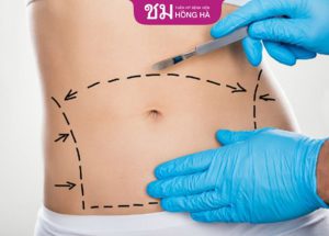 Kinh nghiệm sau hút mỡ bụng từ chuyên gia thẩm mỹ hàng đầu