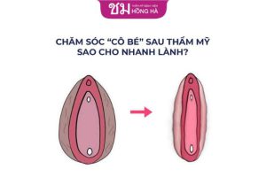 Kinh nghiệm thẩm mỹ vùng kín an toàn, bền đẹp
