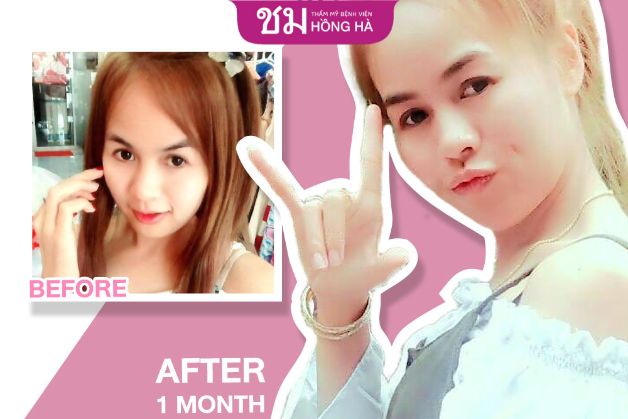 Khuôn mặt duyên dáng hơn khi tạo lúm đồng tiền