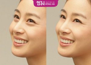 Lấy mỡ bọng mắt: Loại bỏ bọng mỡ, trẻ hóa mắt hiệu quả