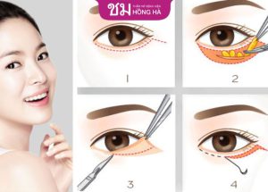 Lấy mỡ bọng mắt có đau không? 4 Cách ngăn ngừa tái phát