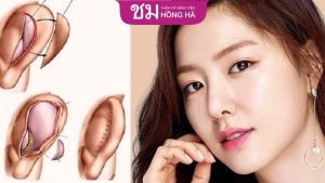 Nâng mũi bằng sụn tai có đau không – Chăm sóc nhanh phục hồi