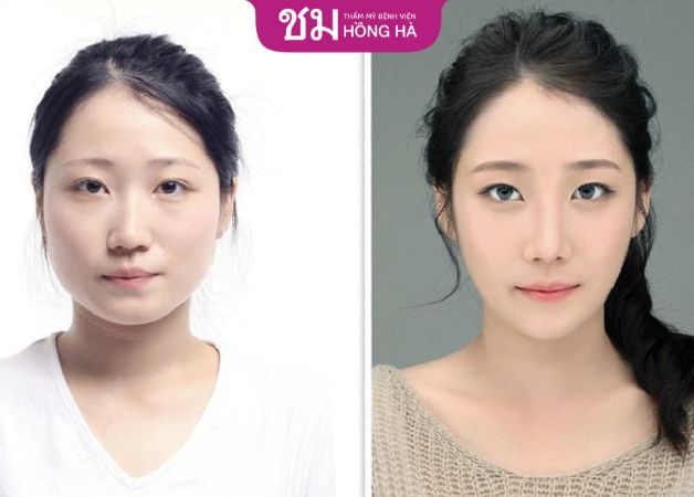 Khuôn mặt trở nên thon gọn, hài hòa hơn