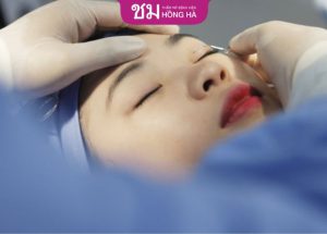 Cắt mí Thai Eyelid: Giải pháp khắc phục triệt để khuyết điểm của mắt