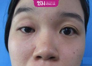 Mắt to mắt nhỏ: Nguyên nhân, ảnh hưởng và cách khắc phục triệt để