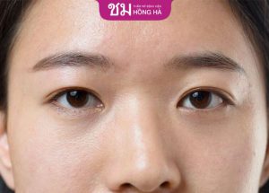 Mí lót: Khắc phục mí lót thành 2 mí đẹp an toàn