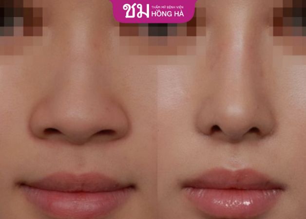 Phương pháp này giúp cho tình trạng mũi thon gọn tránh thô kệch
