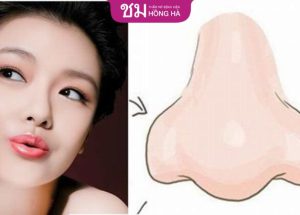 Có nên chỉnh sửa dáng mũi củ tỏi hay không?