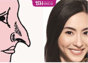 Mũi diều hâu: Phương pháp chỉnh hình mũi diều hâu hiệu quả