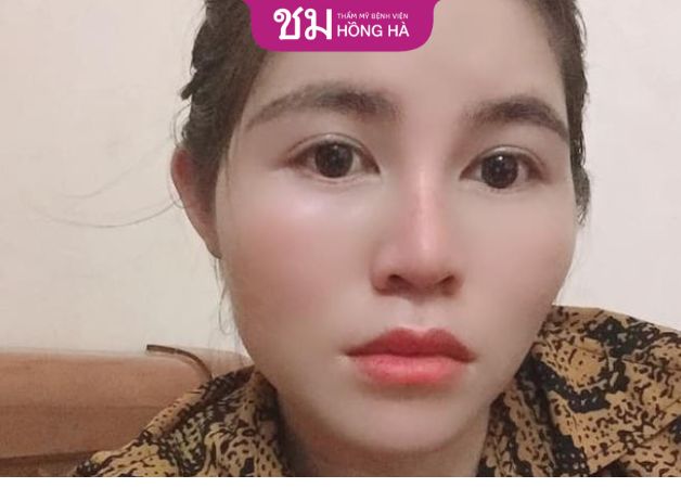 Người mũi lệch có tình duyên trắc trở khó thăng tiến