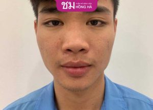 Đặc điểm của mũi ngắn là gì? Mũi ngắn phải làm sao?