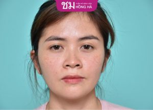 Mũi tẹt: Vận số và cách khắc phục hiệu quả