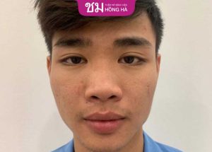 Mũi to do đâu? Cách khắc phục mũi to như thế nào?