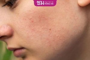 Mụn ẩn : 6 Cách đánh bật mụn ra khỏi làn da và ngăn ngừa mụn ẩn