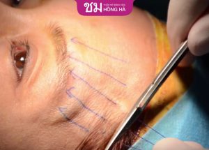 Nâng cung mày: Giải pháp trẻ hóa, cải thiện mí mắt sụp