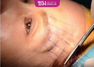 Nâng cung mày không phẫu thuật – Lưu ý chăm sóc