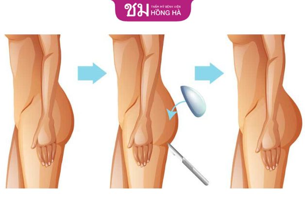 Nâng mông sử dụng túi độn là một trong những phương pháp phổ biến