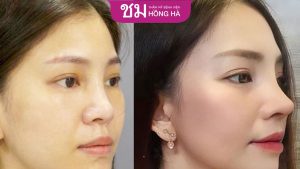 Nâng mũi Thai Shape: Xu hướng nâng mũi đẹp chuẩn Thái