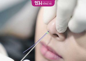 Nâng mũi bằng chỉ collagen là gì? Có tốt không? Hiệu quả bao lâu